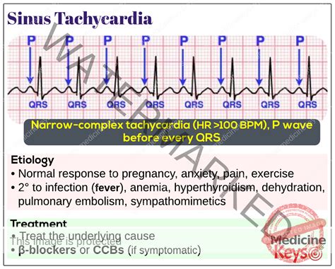 Sinus tachycardia - Medicine Keys for MRCPs