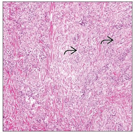 Riedel Thyroiditis | Basicmedical Key