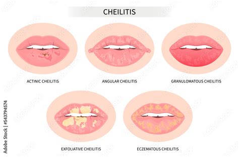 Types of dry lip fungal oral cold sore skin pain tongue Licker's ...