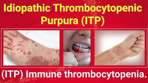 Thrombocytopenic Purpura