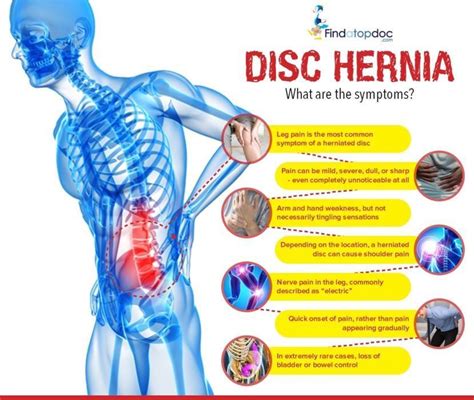 Herniated Disc: Symptoms, Causes, Treatment, and Diagnosis | FindATopDoc