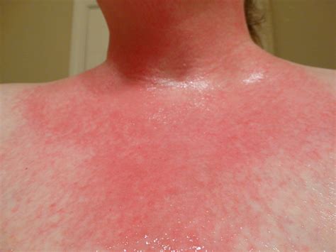 allergic reaction rash pictures - pictures, photos