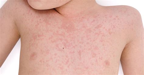 German Measles (Rubella): Causes, Symptoms, Treatments, and Home Remedies