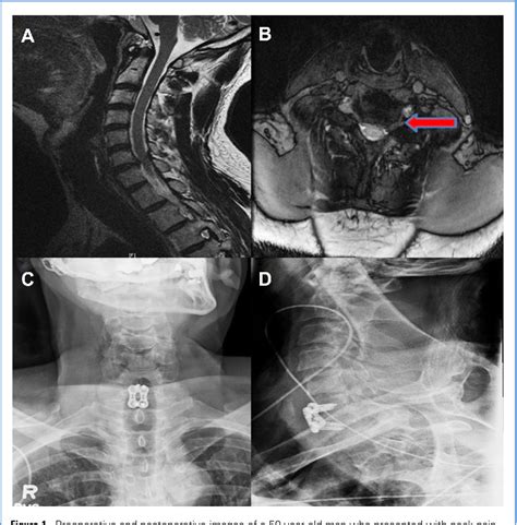 Figure 2 from Surgical complications of anterior cervical diskectomy ...