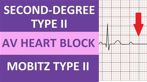 Second-Degree Type 2 Heart Block ECG Rhythm Nursing NCLEX | Mobitz Type II - YouTube