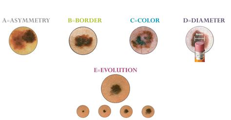 Cancerous Moles Vs Normal Moles