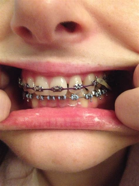 Stouffville Orthodontist Does My Braces: I'm a Dental Hygienist Getting ...