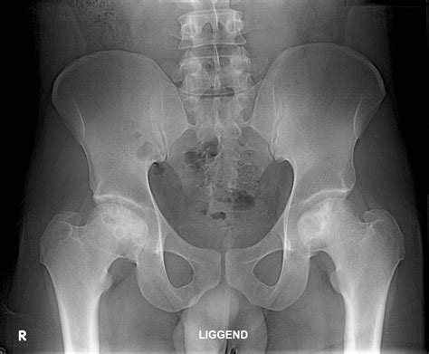 Normal Pelvis X Ray