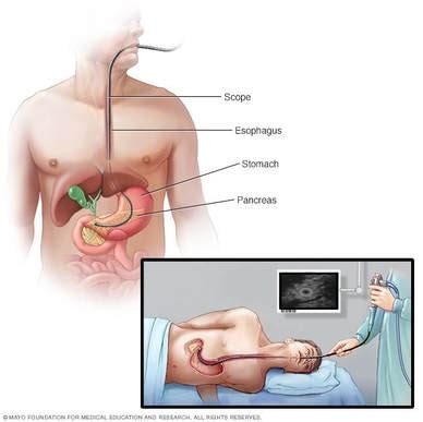 Surgery for Pancreatic Cancer (Overview) - THE OLIVE LABORATORY