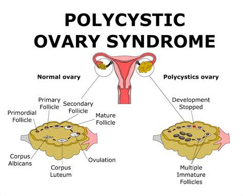 Mohak Infertility Center: What is polycystic ovary syndrome?