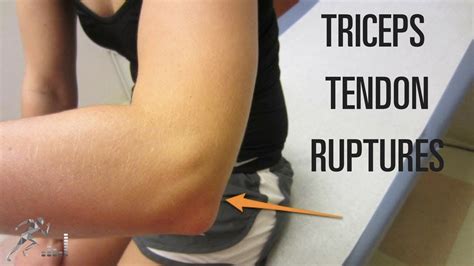 Triceps tendon rupture: Mechanism of injury and treatment - YouTube