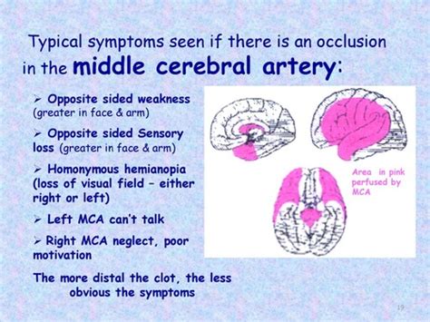 stroke Flashcards | Quizlet