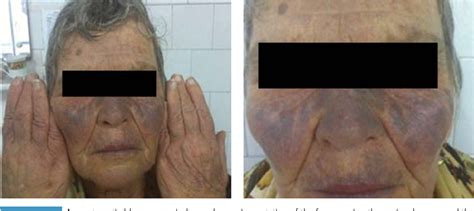 Figure 1 from AMIODARONE-INDUCED SKIN PIGMENTATION : TWO CLINICAL CASES ...