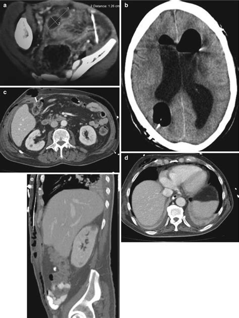 Neuroimaging in CSF Shunt Complications | Neupsy Key