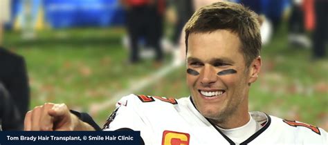 Tom Brady Hair Transplant - Smile Hair Clinic