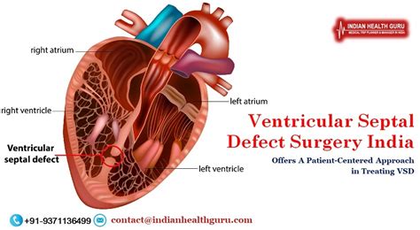 Ventricular Septal Defect Surgery India Making It Easy And Safe ...