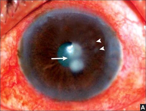 Clinical Presentation of Fungal Keratitis | Tuyenlab