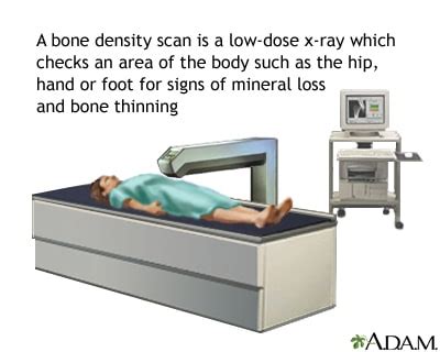 Bone Density Testing for Osteoporosis | In Office Dexa Scans!