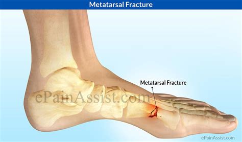 Metatarsal Fracture: Treatment, Causes, Symptoms