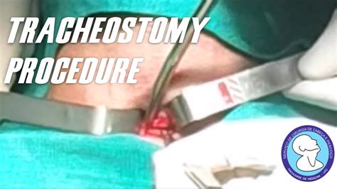 TRACHEOSTOMY PROCEDURE – THE FIRST PERFORMED BY THE GENERAL SURGERY ...