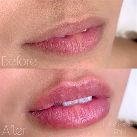 Needleless Lip Filler Pen | Chin Reduction Non Surgical in CT