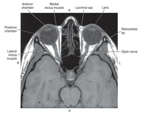 Orbits Axial MRI | Rectus muscle, Optic nerve, Mri