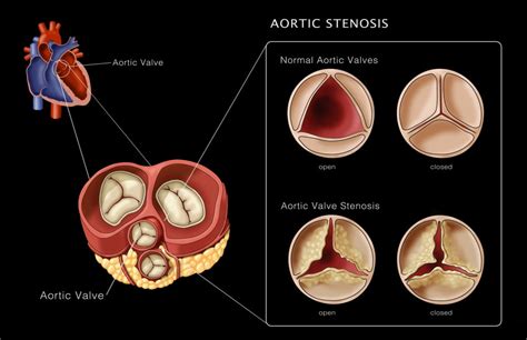 Normal Aortic Valve Gradient