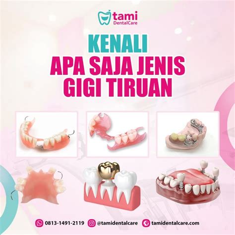 Jenis-jenis Gigi Tiruan yang harus kamu tahu! – Tami Dental Care ...