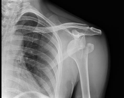 ANTERIOR SHOULDER DISLOCATION WITH FRACTURE | buyxraysonline