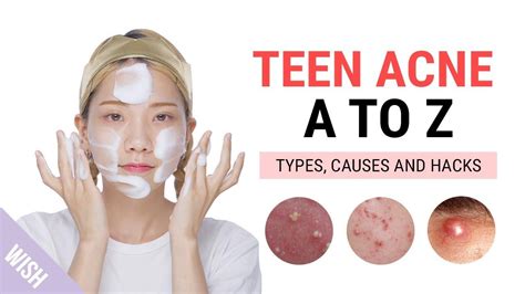 Best Acne Treatment For Teen Boys - shearlingwomenbestquality