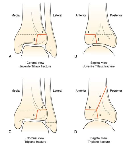 Tough day: Triplane fracture | Radiology Key