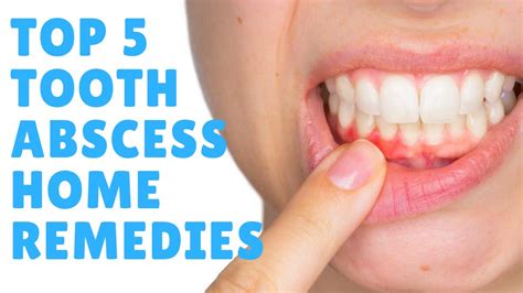 Tooth Abscess: Top 5 Tooth Abscess Home Remedies & Treatments - GET ...