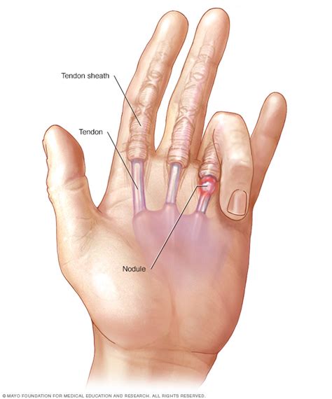 Trigger finger Disease Reference Guide - Drugs.com