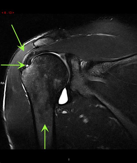 PRP for Small Rotator Cuff Tear (Shoulder) | Cedars-Sinai