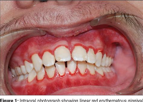 Linear Gingival Erythema