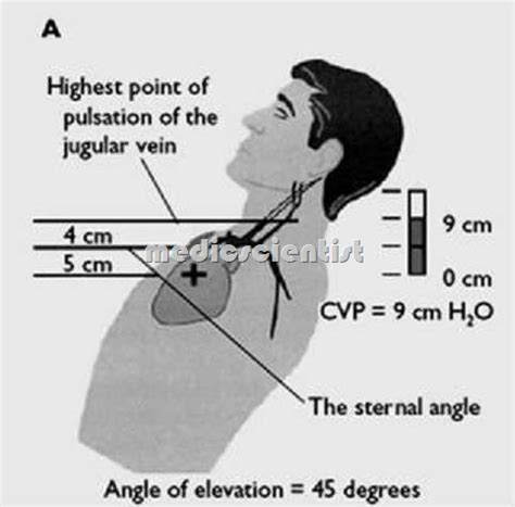 Examination of arterial pressure pulse with Jugular Venous Pulse (JVP ...