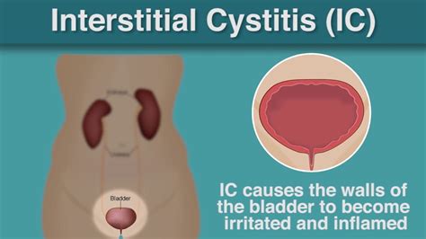 Interstitial Cystitis - Symptoms And Causes