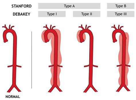 Aortic Dissection - Type A And B - Symptoms, Causes, Treatment