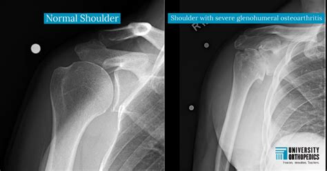 Shoulder Arthritis: Treatment for Younger, Active Patients - University ...