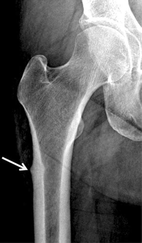 Severe Osteoporosis X Ray