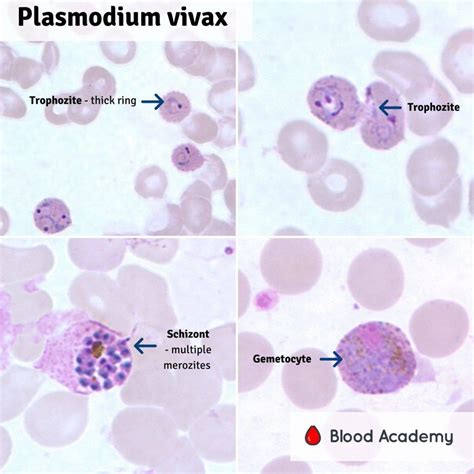 Plasmodium Vivax - Blood Academy