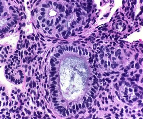 Pathology Outlines - Adenomatoid odontogenic tumor