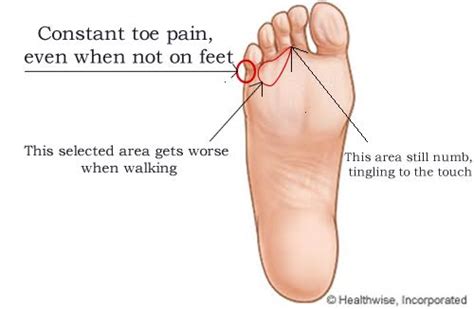 Foot and Ankle Problems By Dr. Richard Blake: Nerve Pain: Possibly ...