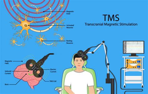 What is Neurostimulation Therapy? - Psychiatry & Psychological Services ...