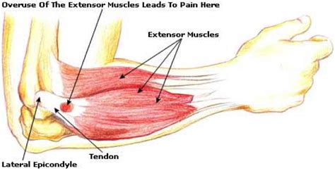 What causes tennis elbow and how you can alleviate some of your ...