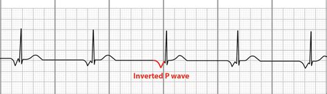 Junctional Bradycardia Rhythm Strip