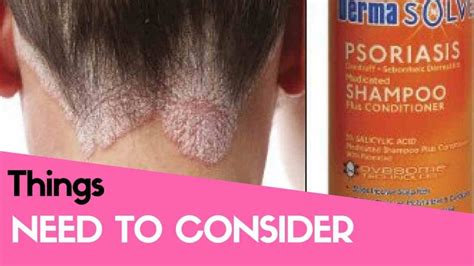 The Best Shampoos for Scalp Psoriasis: Reviews and Buyer's Guide