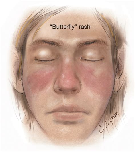 Systemic Lupus Erythematosus | Dermatology | JAMA | JAMA Network