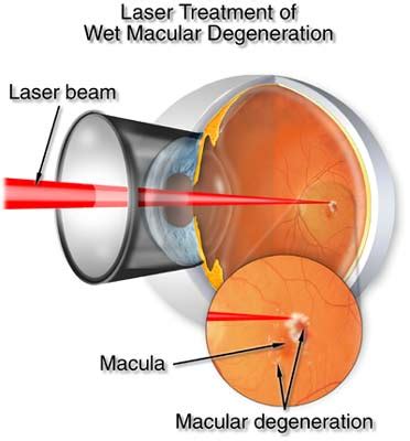 Age-related macular degeneration treatments - Atlas Eye