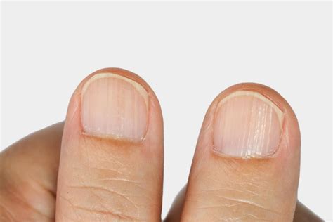 Ridges in fingernails: Types, causes, and treatment